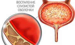 Как проводится инстилляция уретры у мужчин и женщин