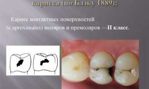 Классификация кариеса зубов по Блэку и по системе ВОЗ, особенности препарирования кариозных полостей