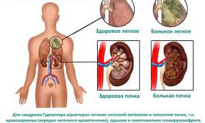 Гудпасчера синдром: проявление симптомов, диагностика и лечение