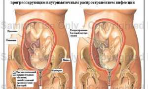Преждевременный разрыв плодных оболочек: причины, симптомы, риски