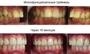 Детские и взрослые трейнеры для зубов: разновидности, показания, правила ношения, стоимость