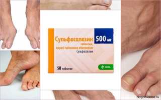 Полная инструкция по применению Сульфасалазина при ревматоидном артрите