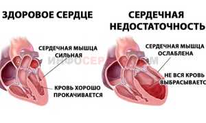 Как лечить одышку при сердечной недостаточности?