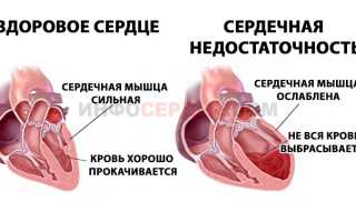 Как лечить одышку при сердечной недостаточности?