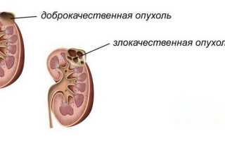 Признаки гипернефромы почек: лечение и прогноз