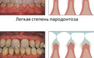 Что такое пародонтоз: причины, стадии развития и лечение
