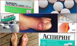 Применение йода и аспирина при подагре
