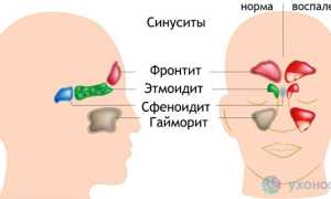 Фронтит: как развивается, проявления, диагностика, тактика лечения
