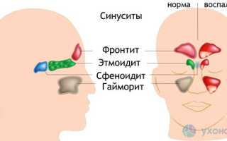 Фронтит: как развивается, проявления, диагностика, тактика лечения