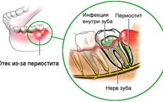 Периостит челюсти: что это такое и как лечить