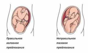 Как родить при аномальном предлежании плода