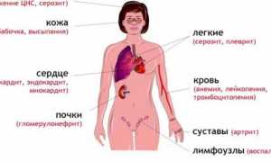 Совместимы ли системная красная волчанка и беременность