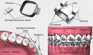Керамические брекеты: фото до и после установки керамической брекет-системы, преимущества и недостатки, стоимость
