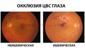 Тромбоз сосудов и центральной вены сетчатки глаза