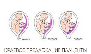 Краевое предлежание плаценты