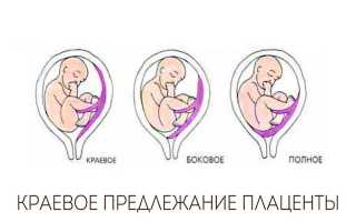 Краевое предлежание плаценты