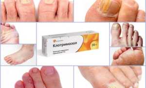 Клотримазол мазь и крем от грибка ногтей