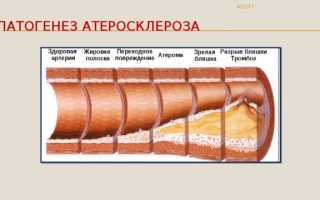 Этиология и патогенез атеросклероза — стадии развития заболевания сосудов