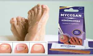Микозан