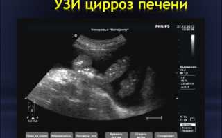 Что показывает УЗИ печени: показания, подготовка, проведение, диагнозы, цены
