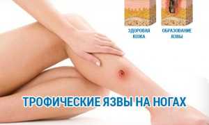 Что такое трофическая язва на ноге и как ее лечить?
