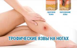 Что такое трофическая язва на ноге и как ее лечить?