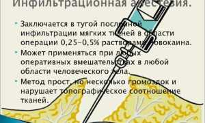 Инфильтрационная анестезия: виды, техника проведения, преимущества и недостатки