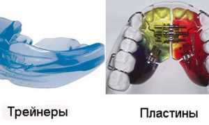 Кривые зубы у детей и взрослых: причины, методы исправления