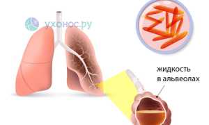 Легионеллез: возбудитель, формы, признаки, терапия, профилактика