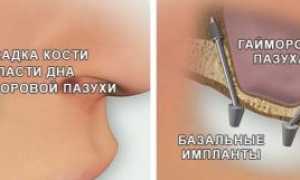 Базальная имплантация: что это такое, плюсы и минусы, этапы установки зубных протезов, осложнения