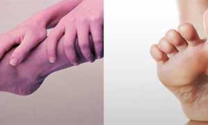 Почему немеют пальцы на ногах — что делать, как лечить онемение?