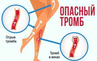 Как и почему отрывается тромб, что делать, можно ли спасти человека от мгновенной смерти?