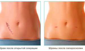 Все что нужно знать пациенту о швах после лапароскопии