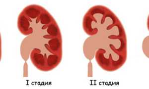 Гидроуретеронефроз — патология почек и мочевыводящих путей