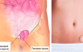 Паховая грыжа при беременности