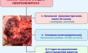 Причины возникновения шоковой почки: симптомы, лечение и прогноз