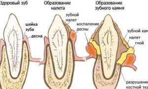Зубной камень: что это такое, причины, как бороться