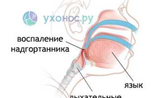 Гемофильная инфекция: возбудитель, клиника, как лечить, вакцинация