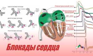 Что такое блокада сердца, какие у нее степени, методы лечения
