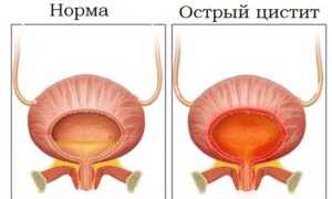 Лечение цистита народными средствами с помощью пшена