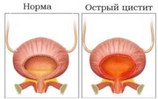 Лечение цистита народными средствами с помощью пшена
