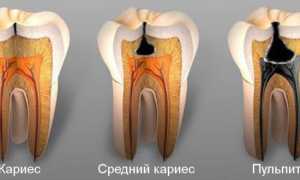 Почему болит зуб при нажатии, надавливании и надкусывании