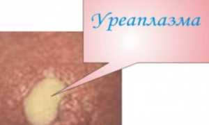Соскоб на уреаплазму