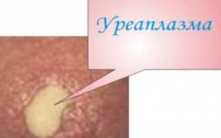 Соскоб на уреаплазму