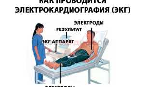 Что такое синусовый ритм сердца?