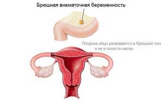 Брюшная беременность