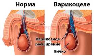 Что такое проба и прием Вальсальвы и для чего они используются?