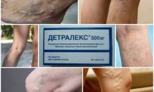 Как принимать Детралекс при варикозе — инструкция и рекомендации