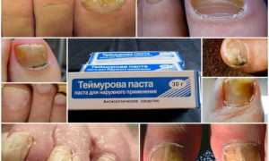 Применение пасты Теймурова от грибка ногтей