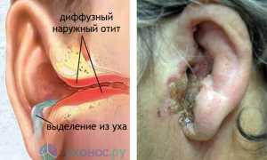 Отит: причины, виды, признаки, диагностика, как лечить, профилактика